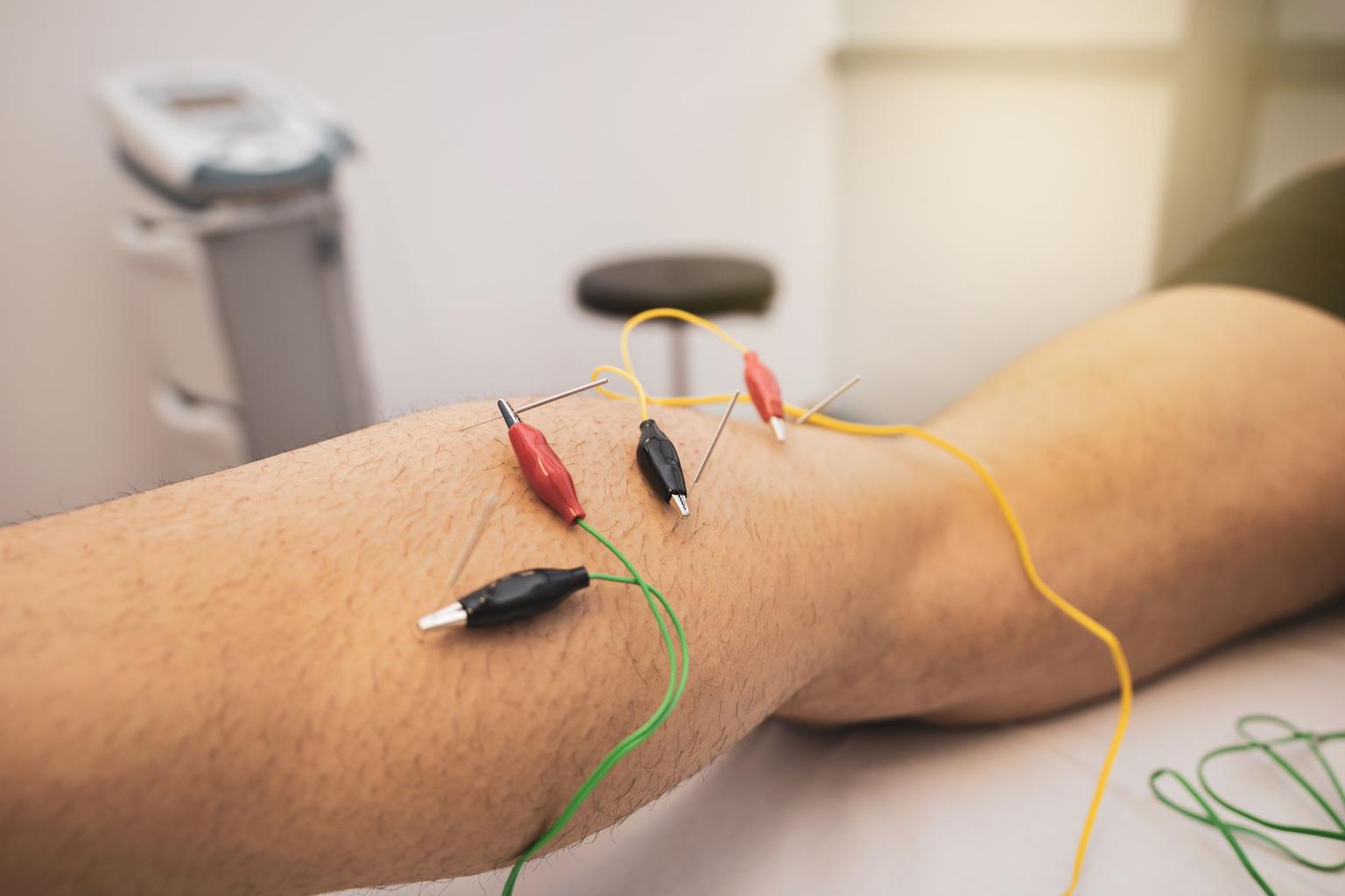 What is the Difference Between Neurological Dry Needling, Trigger Point Dry Needling, and Electrical Muscle Stimulation Dry Needling?