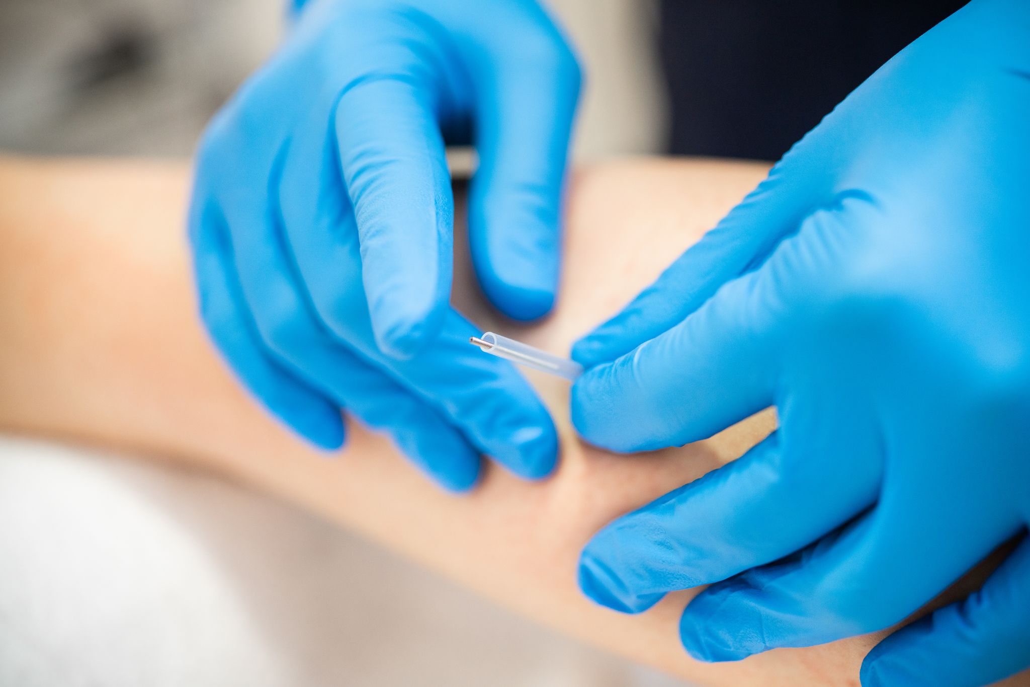 Dry Needling for Injury Prevention: What to Know
